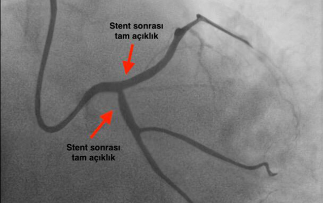 ege-hospitalda-daha-bir-riskli-emeliyyat